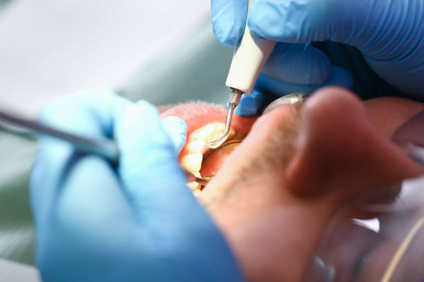 Best Emergency Wisdom Tooth Extraction in Trenton, IL