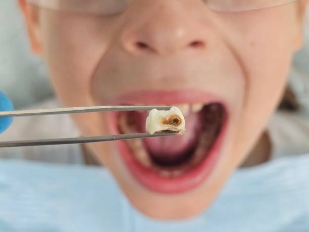 Best Emergency Root Canal Therapy in Trenton, IL